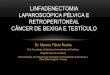 Linfadenectomia laparosc³pica p©lvica e retroperitoneal