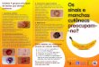 Folheto de Fotoeducação Manchas, Sinais e Cancro Cutâneo 2