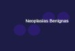 Neoplasias Benignas. NEOPLASIA Crescimento novo Perda de responsividade aos controles do crescimento normal