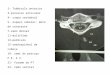 SISTEMA NERVOSO 2- Tubérculo anterior 3-processo articular 4- corpo vertebral 5- espaço subarac: meio de contraste 7-ramo dorsal 11-multifido 12-pedículo