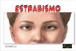 AUTOMÁTICO O estrabismo corresponde à perda do paralelismo entre os olhos. Pessoas com estrabismo são chamadas popularmente de "vesgas". Existem três