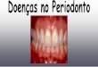 Doenças no Periodonto - · PDF fileVp parvula 20 15 10 5 0 5 10 15 ... Sinais e Sintomas • Prevalência Inicio — progressäo • Achados periodontais • sistêmicas Discrasias