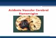 Acidente Vascular Cerebral Hemorrgico .Acidentes vasculares cerebrais: que tipo? 1. Acidentes isqu©micos