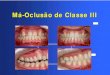 Má-Oclusão de Classe III - Ortodontia em Curitiba ...moroortodontia.com.br/aulaspg/classe III.pdf · indicadores e médio sobre os lábios superior e inferior avaliando a posição