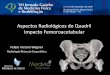 Aspectos Radiológicos do Quadril Impacto Femoroacetabular · Confirma o diagnóstico de Impacto femoroacetabular ... côncava normal do aspecto lateral da cabeça femoral •Extensão