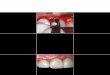 Interrelação Periodontia e Dentística Restauradora na · Interrelação Periodontia e Dentística Restauradora na lapidação de facetas cerâmicas 2013 101 54 12. Modelo A) com