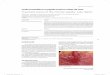 Lesão traumática na papila incisiva: relato de casorevodonto.bvsalud.org/pdf/occ/v12n1/a16v12n1.pdf · A papila incisiva, localizada abaixo do forame incisivo, é uma estrutura