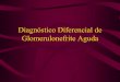 Diagnóstico Diferencial de Glomerulonefrite Aguda · GN Auto anticorpos antimembrana basal glomerular (MBG) • Sem hemorragia Pulmonar • Com Hemorragia Pulmonar (Síndrome de