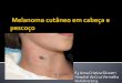 E3 Anna Cristina Silvestri Hospital da Cruz Vermelha ... · Biópsia de linfonodo sentinela Esvaziamento terapêutico Reconstrução 90% dos pacientes com melanoma não tem evidência