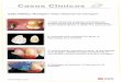 Casos Clínicos - multimedia.3m.commultimedia.3m.com/mws/media/431724O/caso-clinico-impregum.pdf · prótese parcial fixa de 03 elementos. ... 2-Casquete para moldagem do dente 14