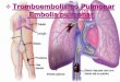 v Tromboembolismo Pulmonar/ Embolia pulmonar 19 - Tromboembolismo...Embolia pulmonar. Forma mais comum de doença pulmonar aguda na população hospitalar adulta (3a causa de óbito
