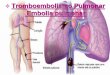 v Tromboembolismo Pulmonar/ Embolia pulmonar ... Sinais e sintomas s££o sutis e inespec£­ficos. a) Trombose
