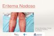 Eritema Nodoso - WordPress.com · El Eritema Nodoso se describe como una paniculitis septal sin vasculitis, caracterizada por nódulos cutáneos de carácter inflamatorio que aparecen